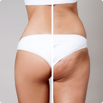 fat_v_cellulite